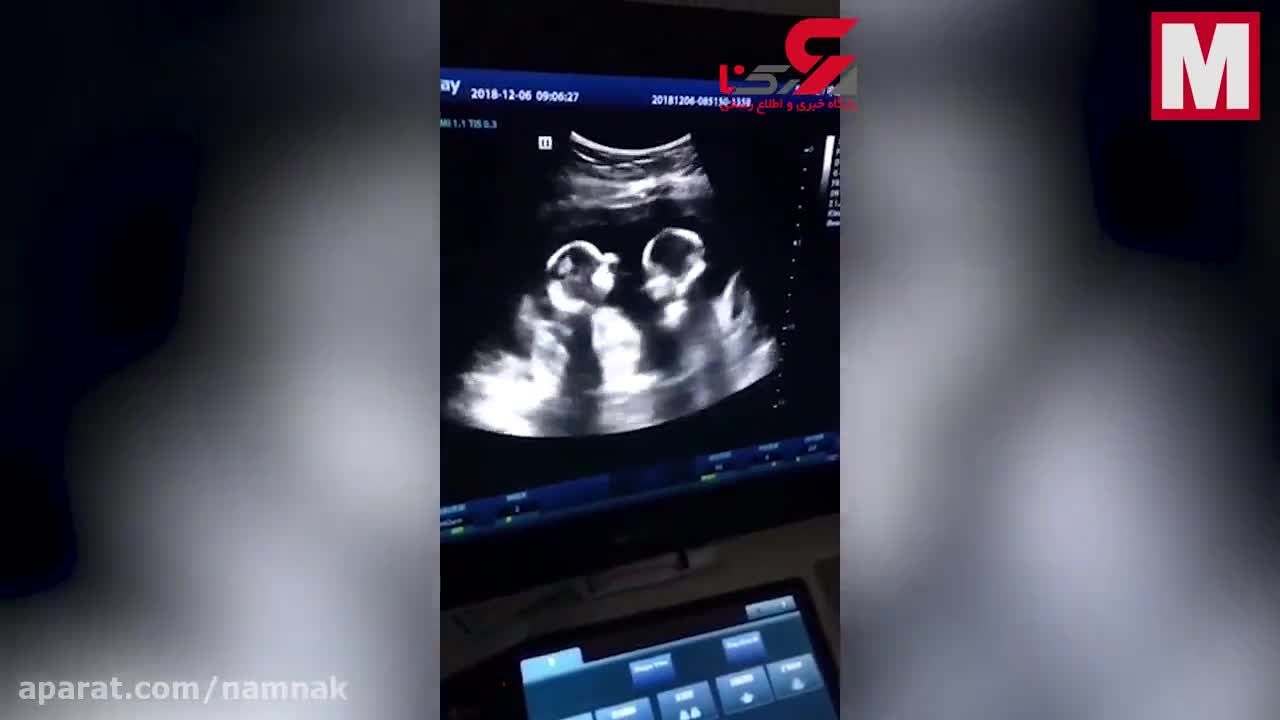 فیلم لحظه دعوای بامزه دوقلوها در رحم مادر چینی